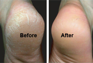Cracked heels