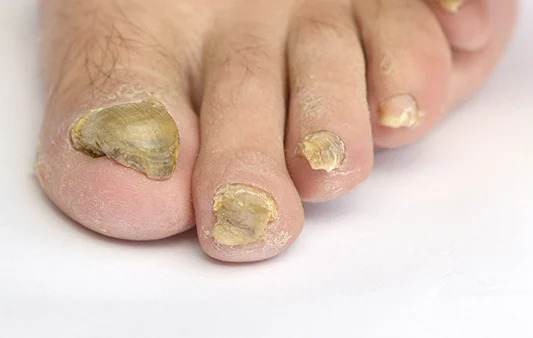 Fungal nail infection
